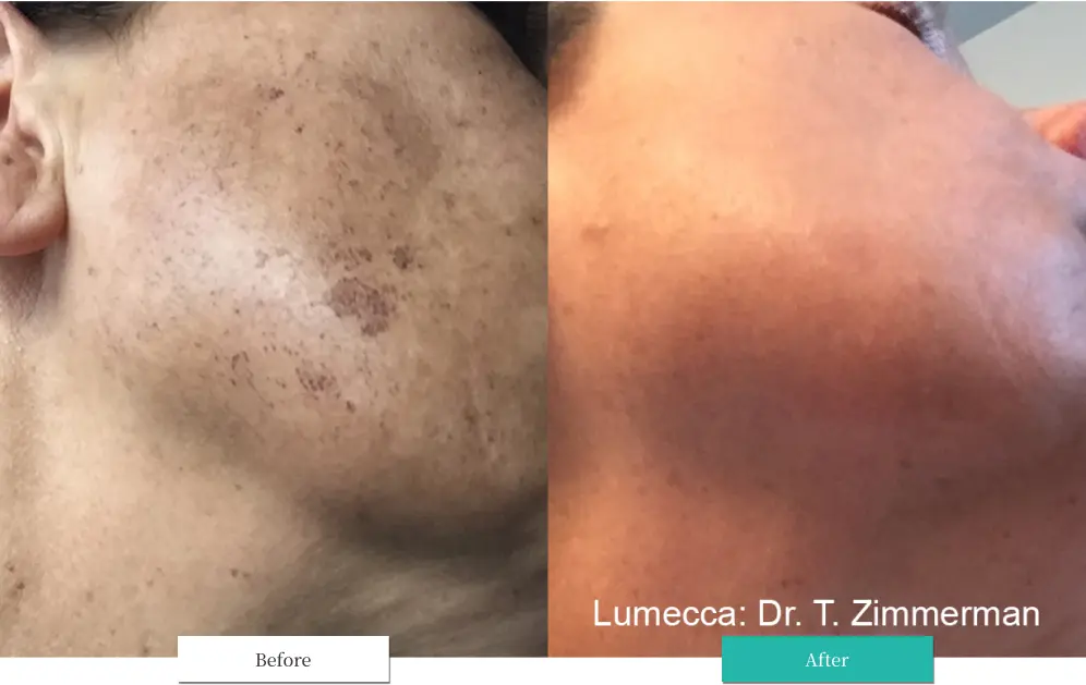 ルメッカ ビフォーアフター画像