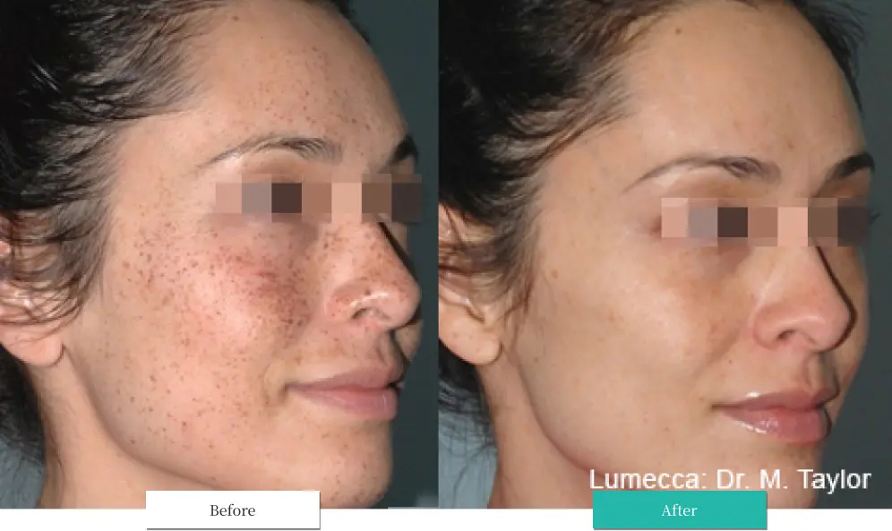 ルメッカ ビフォーアフター画像