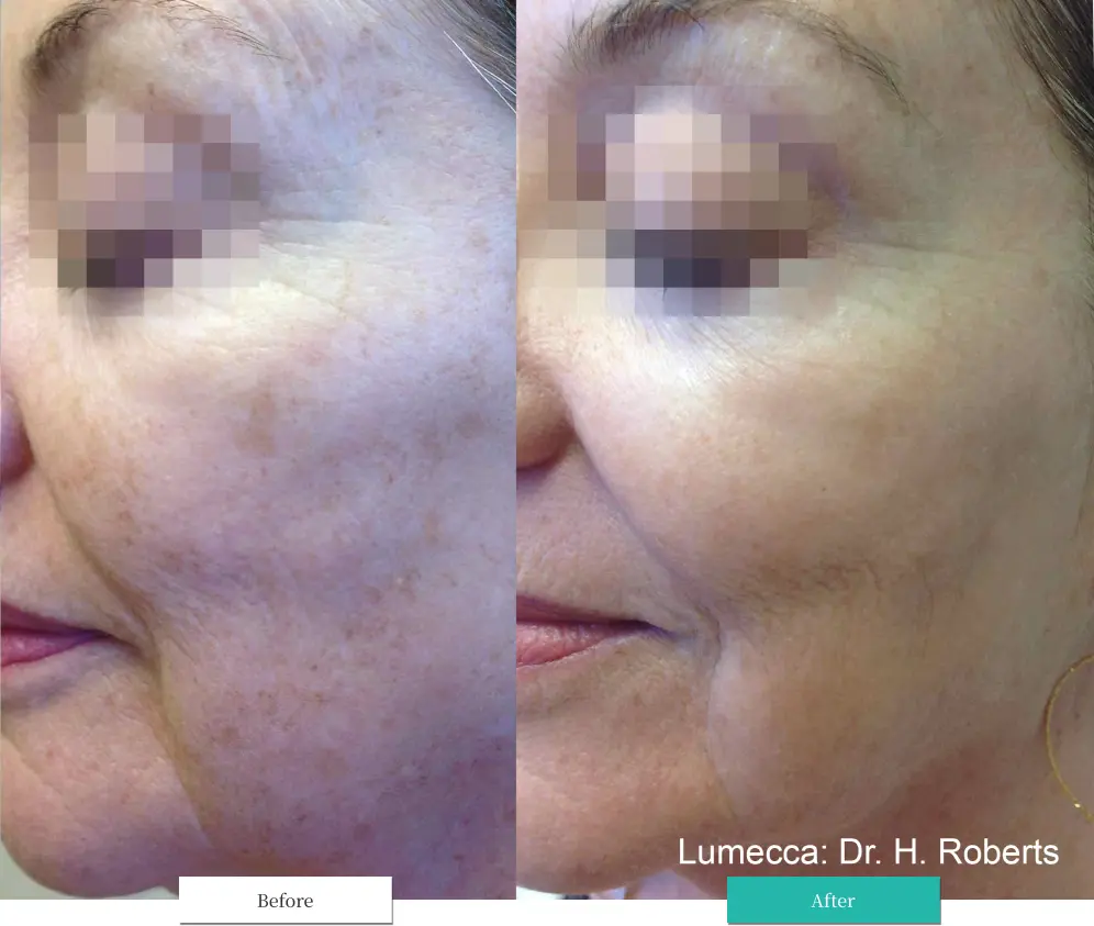 ルメッカ ビフォーアフター画像