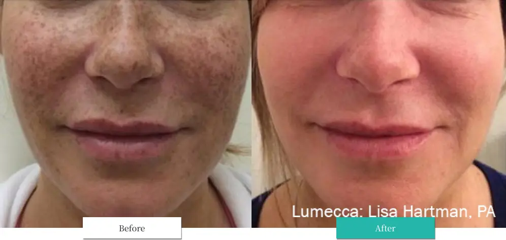 ルメッカ ビフォーアフター画像