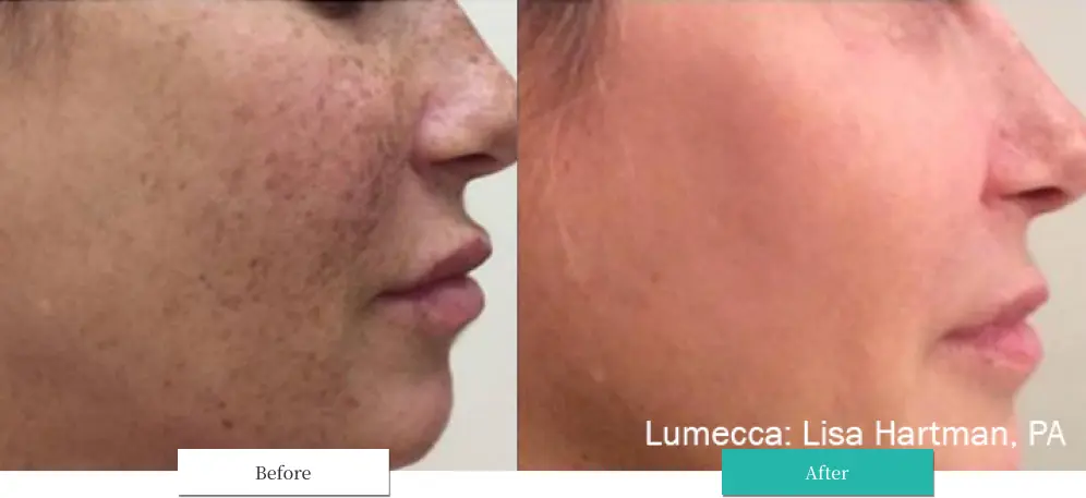 ルメッカ ビフォーアフター画像