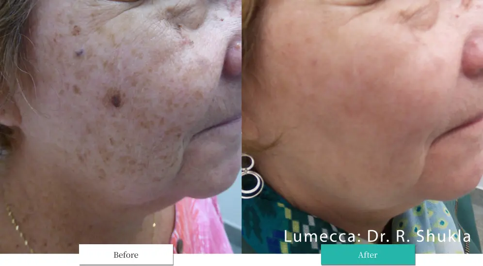 ルメッカ ビフォーアフター画像