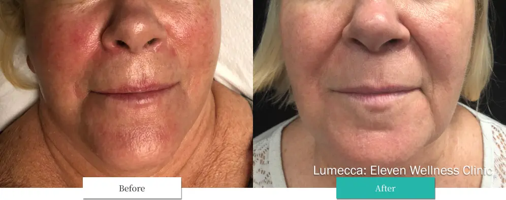 ルメッカ ビフォーアフター画像