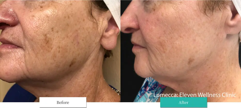 ルメッカ ビフォーアフター画像