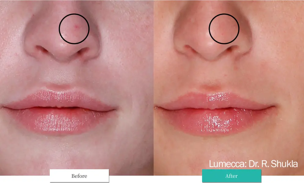 ルメッカ ビフォーアフター画像