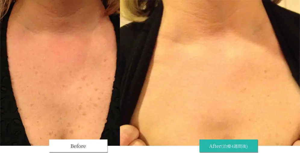 ルメッカ ビフォーアフター画像