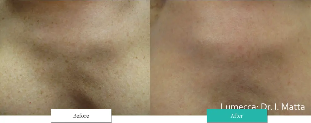 ルメッカ ビフォーアフター画像