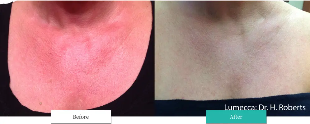 ルメッカ ビフォーアフター画像