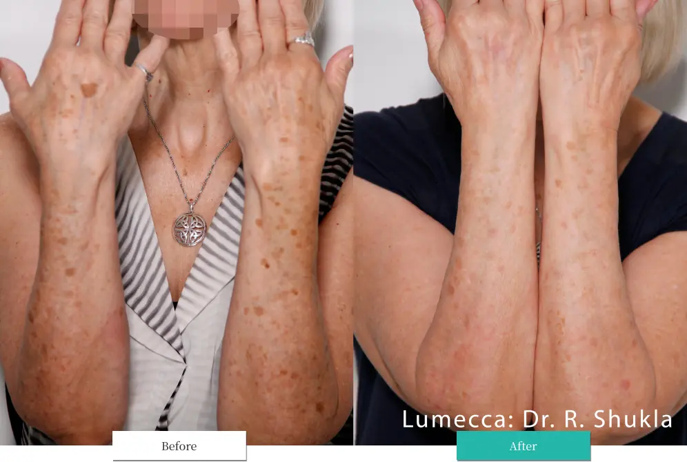 ルメッカ ビフォーアフター画像