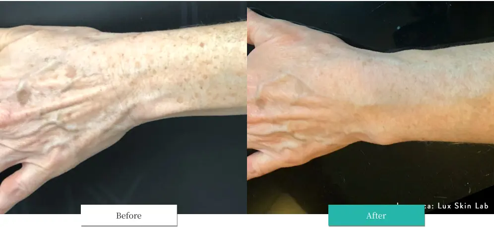 ルメッカ ビフォーアフター画像