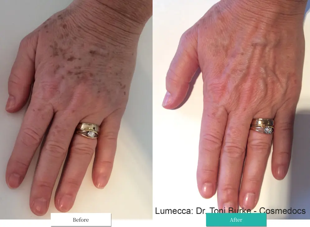 ルメッカ ビフォーアフター画像