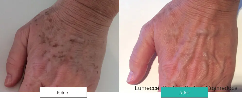 ルメッカ ビフォーアフター画像