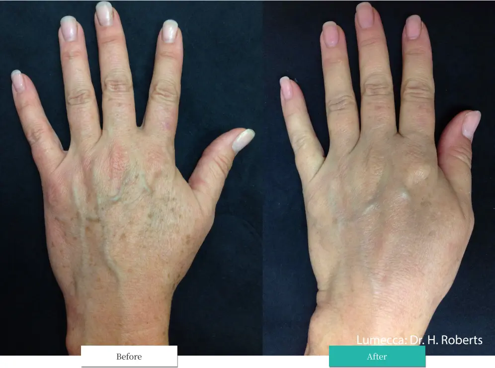 ルメッカ ビフォーアフター画像