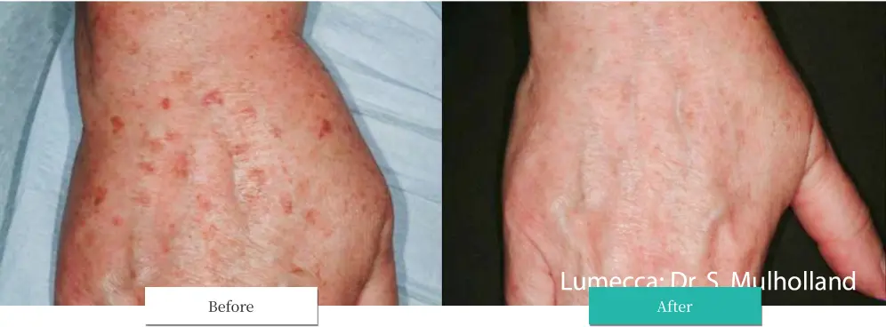 ルメッカ ビフォーアフター画像