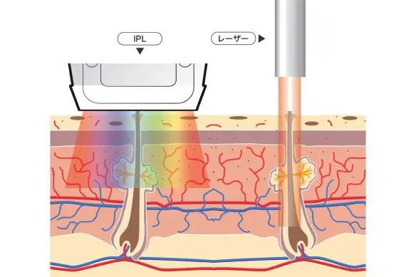IPLと通常のレーザーとの違い