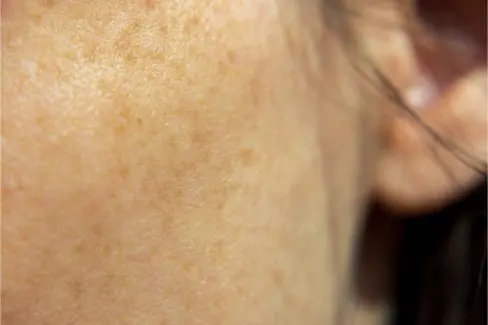 BEAUTY SKIN CLINIC（ビューティースキンクリニック） 革新的シミ治療ルメッカ