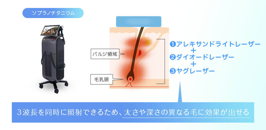 ソプラノチタニウム