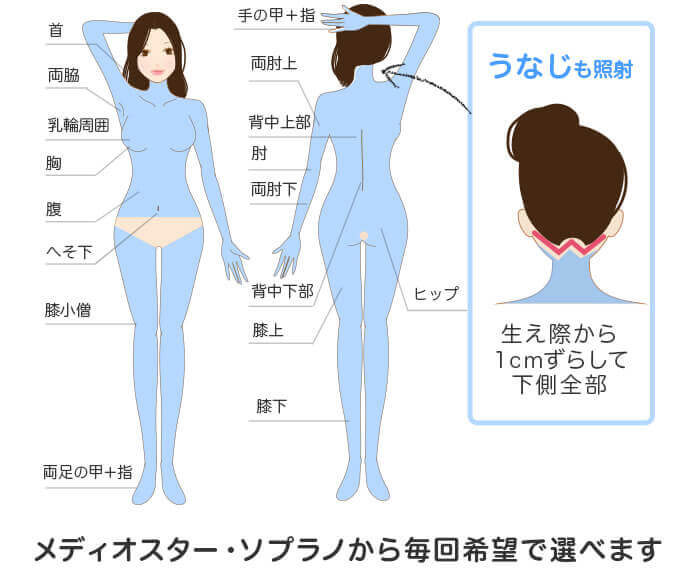 メディオスター・ソプラノ選べる 全身+うなじ医療脱毛の照射範囲
