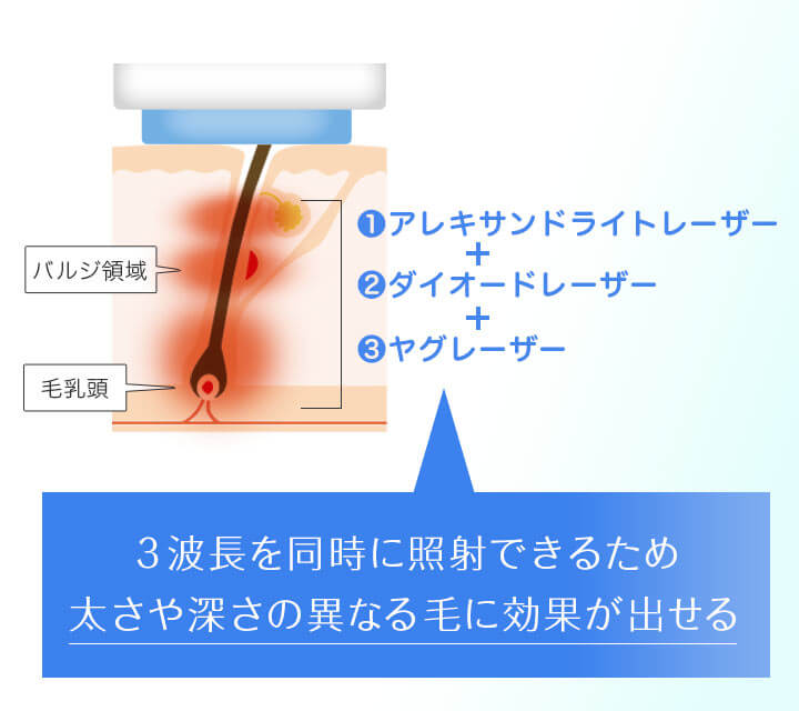 ソプラノチタニウム