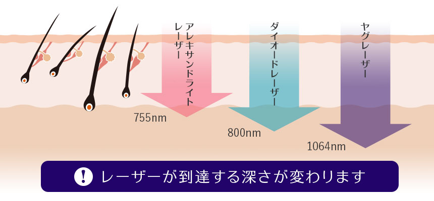 医療脱毛レーザーが到達する深さ アレキンサンドライトレーザー、ダイオードレーザー、ヤグレーザー