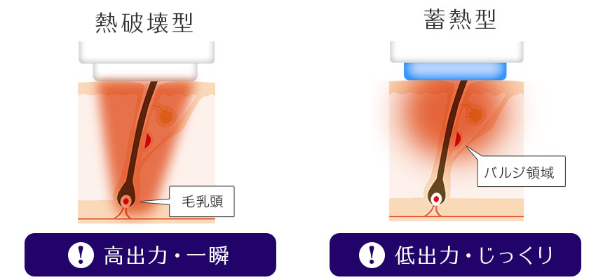 医療脱毛レーザー 熱破壊型と蓄熱型