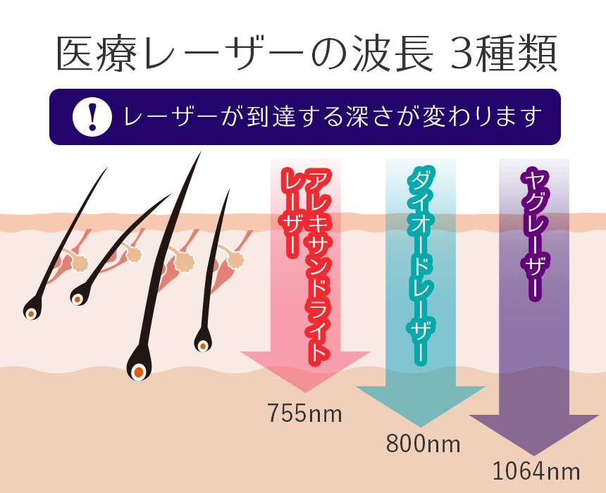 医療脱毛レーザーが到達する深さ アレキンサンドライトレーザー、ダイオードレーザー、ヤグレーザー