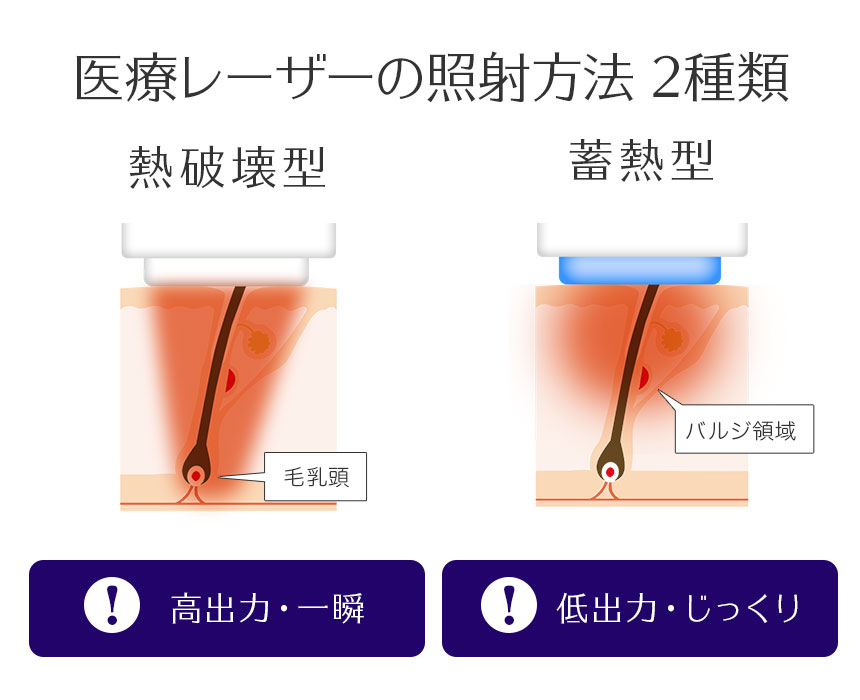 医療脱毛レーザー 熱破壊型と蓄熱型