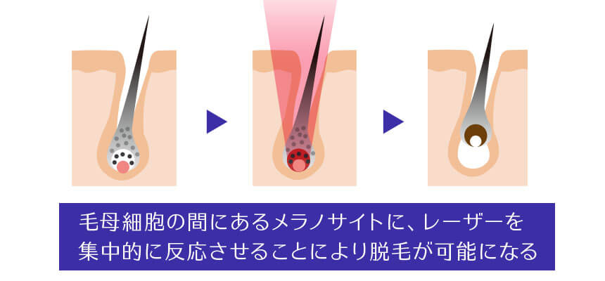 医療レーザー脱毛はメラノサイトを効果的に破壊する