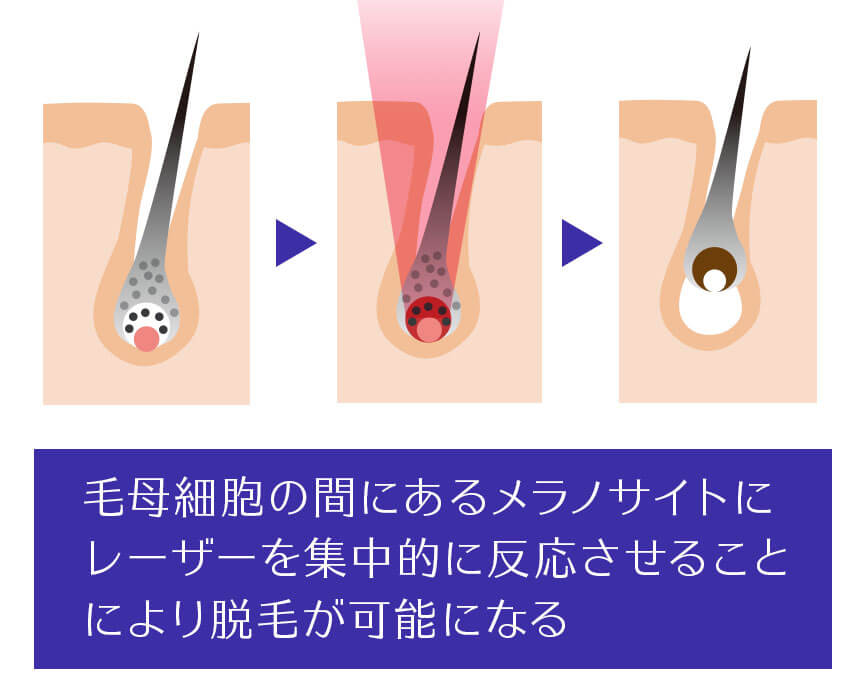 医療レーザー脱毛はメラノサイトを効果的に破壊する