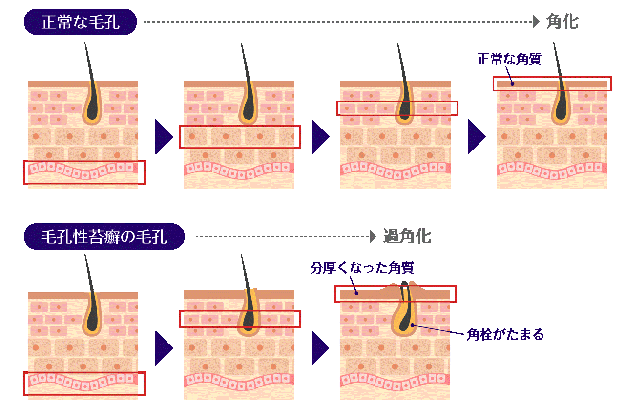 毛孔性苔癬のでき方
