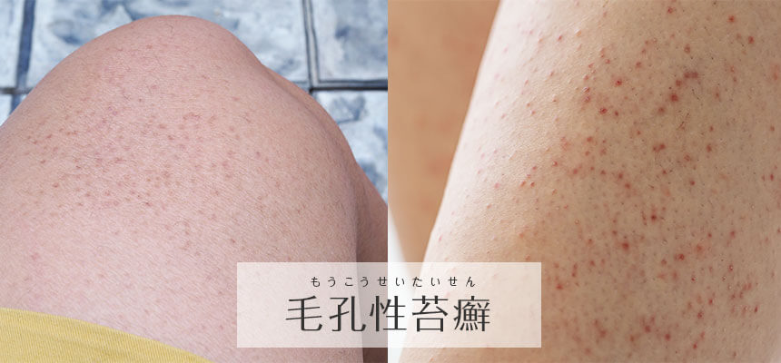 毛孔性苔癬