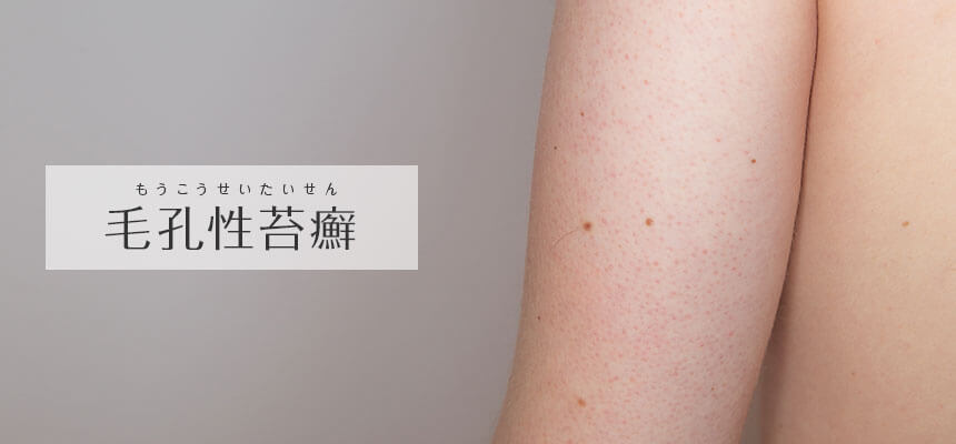 毛孔性苔癬