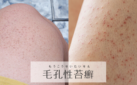毛孔性苔癬