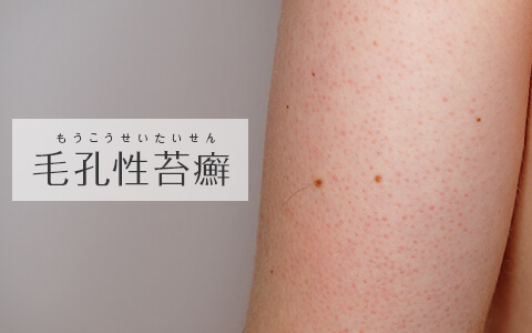 毛孔性苔癬