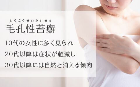 毛孔性苔癬を発症しやすいのは、思春期、特に10代の女性です。20代以降は加齢とともに症状が軽減し、30代以降には自然とぶつぶつが消えていくのが一般的です