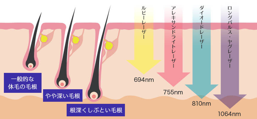 レーザー各種の波長(=脱毛効果の高さ)を比較