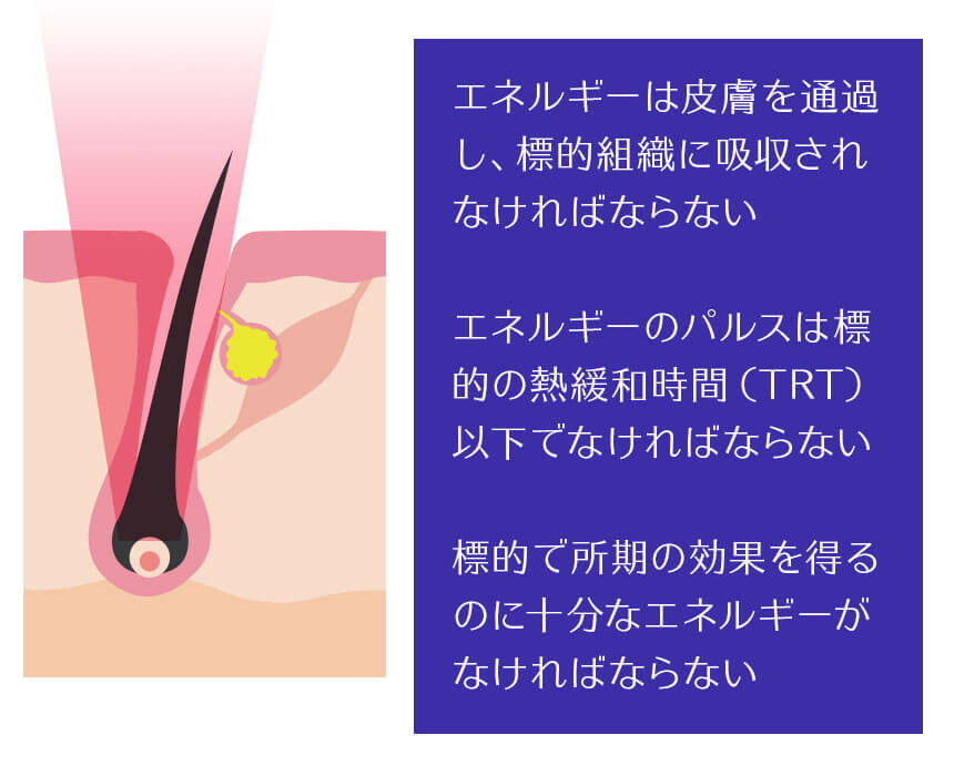 脱毛するためのレーザーの条件