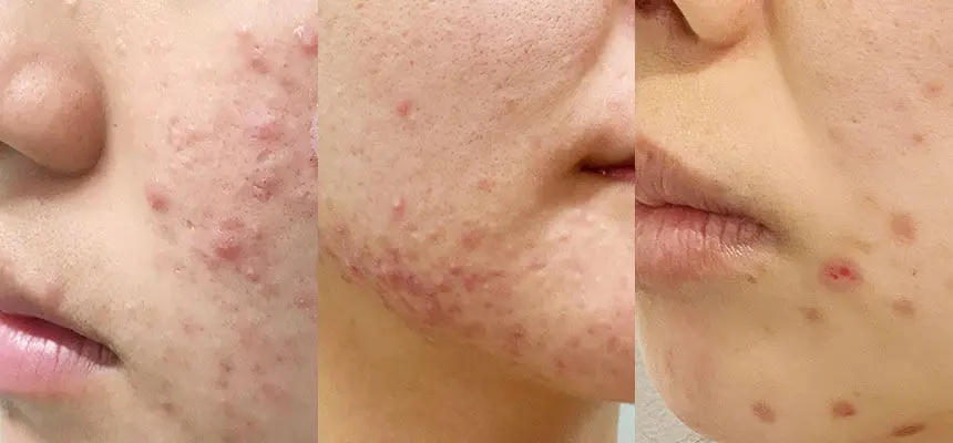 白・褐色・赤・紫‥ 様々なニキビの種類について