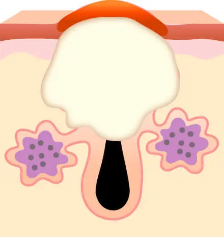 化膿ニキビ