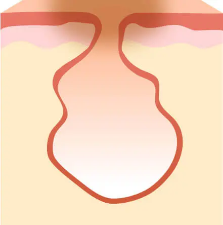 ニキビ跡(色素沈着、クレーター)