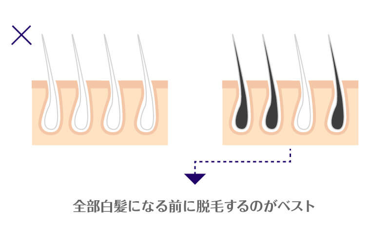 40代・50代のVIO脱毛!白髪が増える前に始めよう