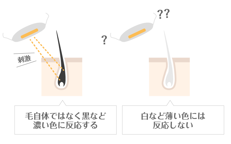VIOの白髪に医療レーザー脱毛の効果ナシ