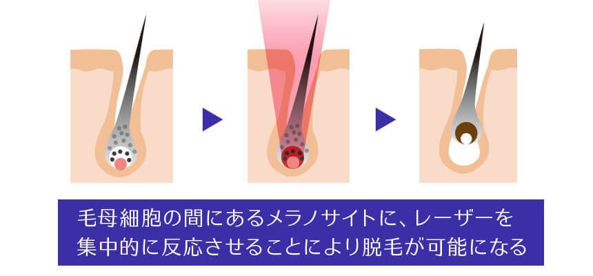 医療レーザー脱毛(熱破壊式)の仕組み