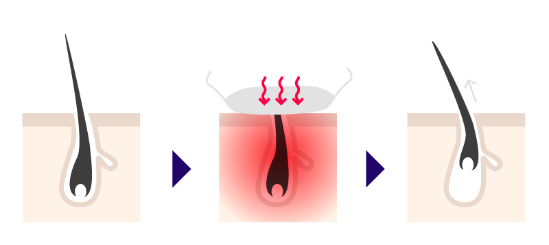 医療レーザー脱毛(蓄熱式)の仕組み