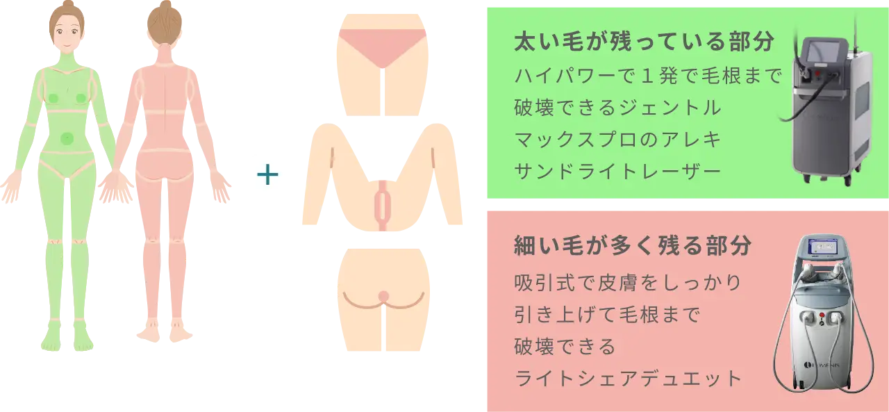 BEAUTY SKIN CLINIC（ビューティースキンクリニック） オールマシンセレクト全身+うなじ 医療脱毛4回完了プラン