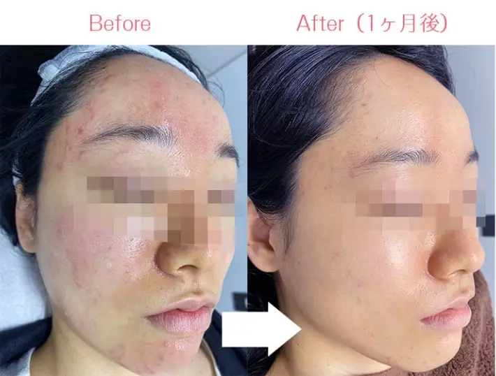 BEAUTY SKIN CLINIC(ビューティースキンクリニック) 治療例