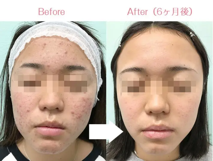 BEAUTY SKIN CLINIC(ビューティースキンクリニック) 治療例