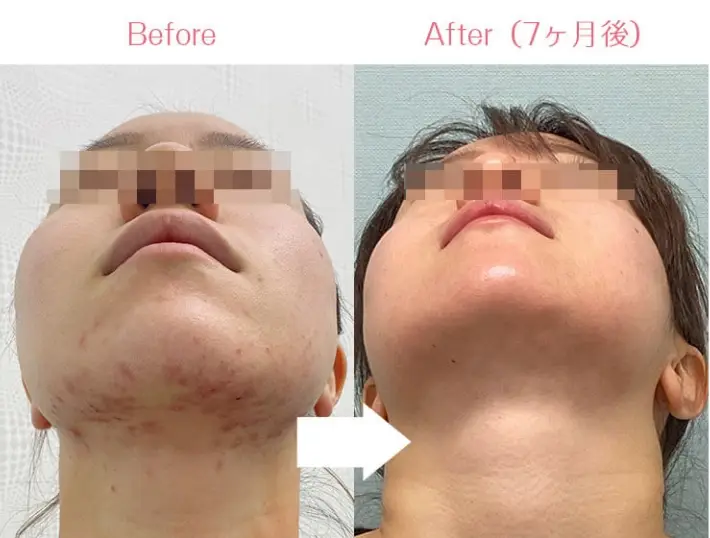 BEAUTY SKIN CLINIC(ビューティースキンクリニック) 治療例