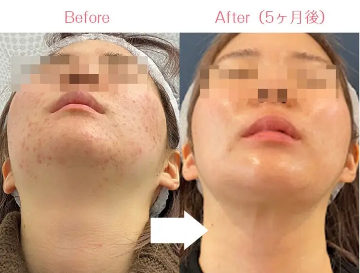 BEAUTY SKIN CLINIC(ビューティースキンクリニック) 治療例