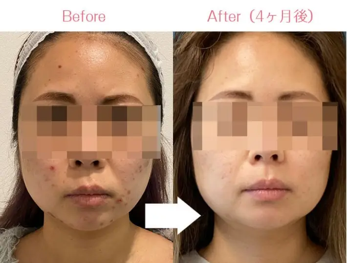 BEAUTY SKIN CLINIC(ビューティースキンクリニック) 治療例